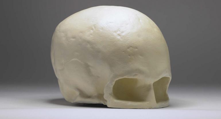 Robert Burns Skull, Writers' Museum